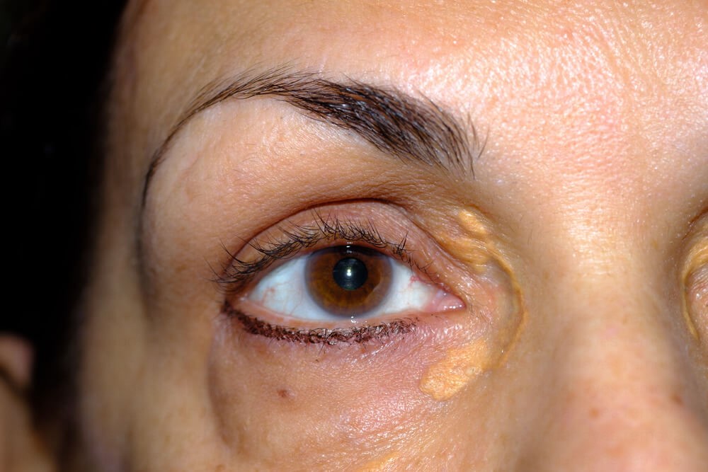 xanthelasma under eyes on eyelids