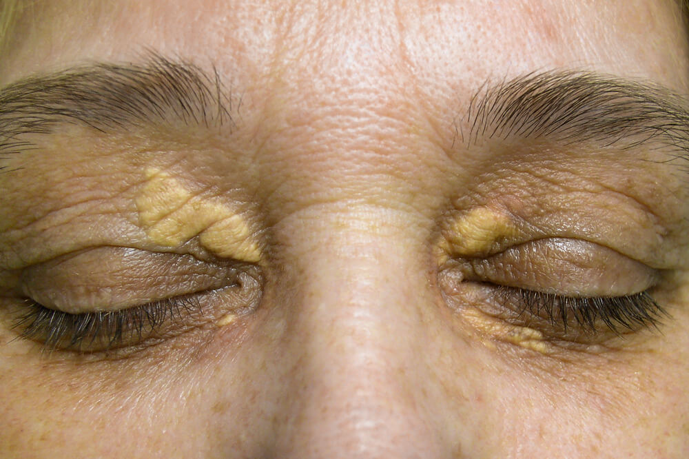 xanthelasma bilateral