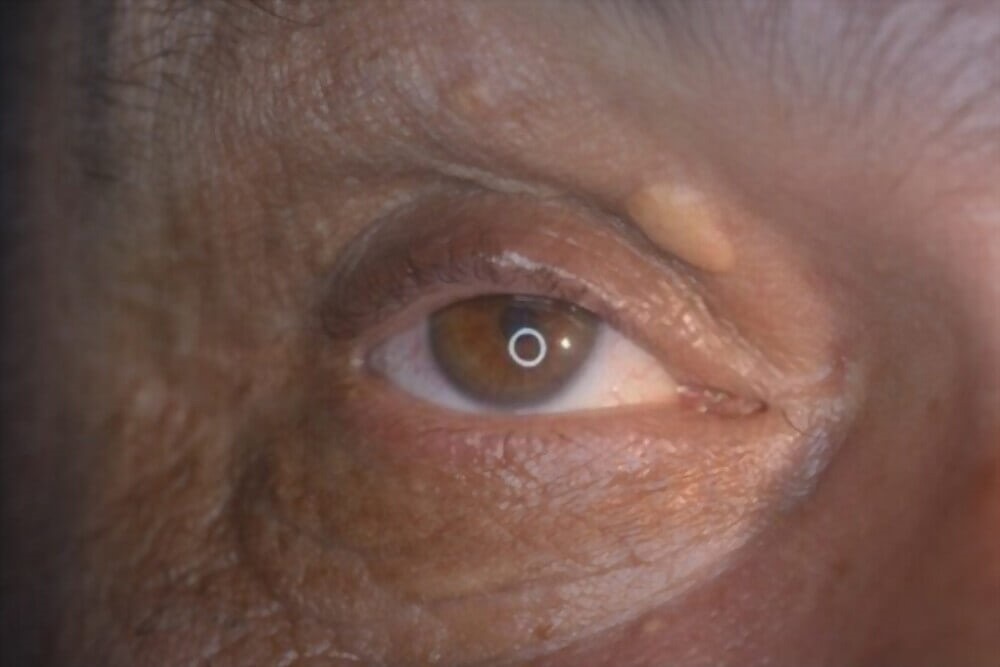Cholesterol concentration in xanthelasma deposits