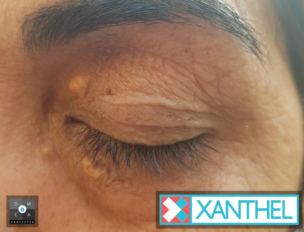 Xanthomas or Xanthelasmas - Navigating the Similarities and Differences