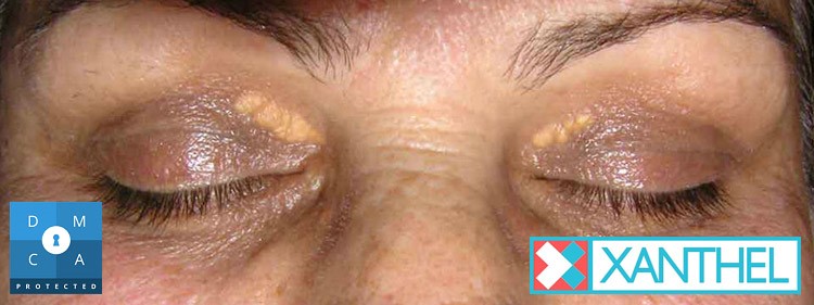 Guide to Xanthelasma Deposits Appearing on Both Eyelids
