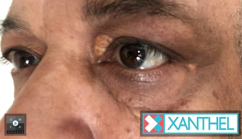 Focus on Periorbital Xanthelasma - Deposits Surrounding the Eyes