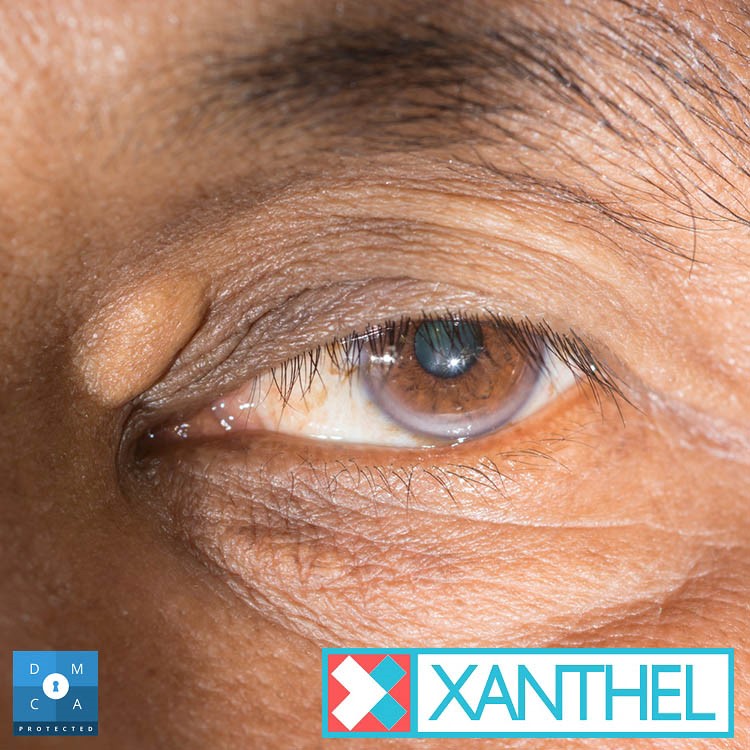 Xanthomas Around the Eyes - A Closer Look at Xanthelasma