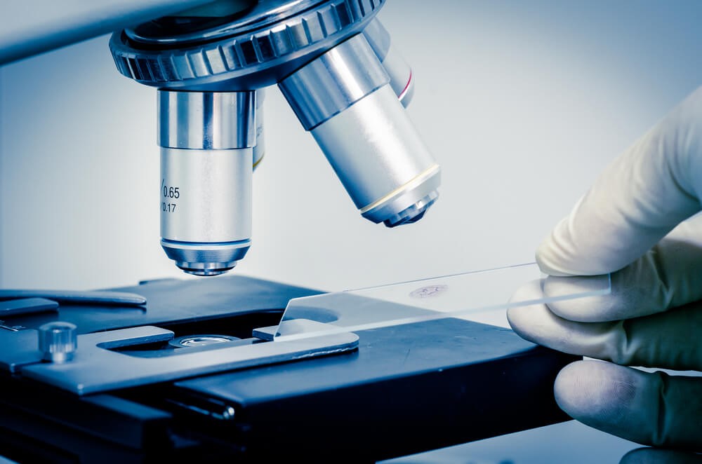 Identifying Triggers - Xanthelasma Causes and Associated Risk Factors