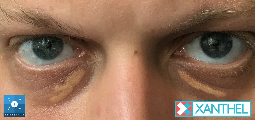 Monitoring Cholesterol - Its Impact on Xanthelasma