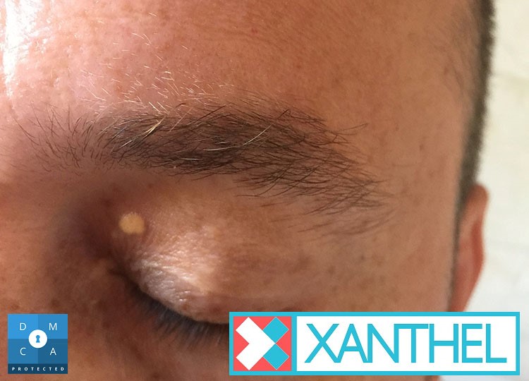 Xanthoma Versus Xanthelasma - A Clear Distinction