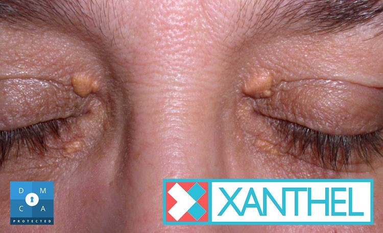 The Onset of Xanthelasma - Exploring Initial Manifestations
