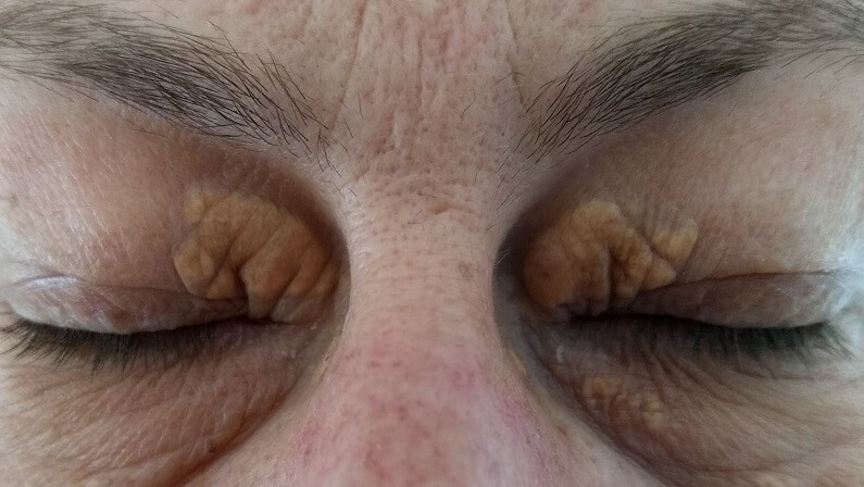 Xanthelasma Explained - Deciphering the Medical Term