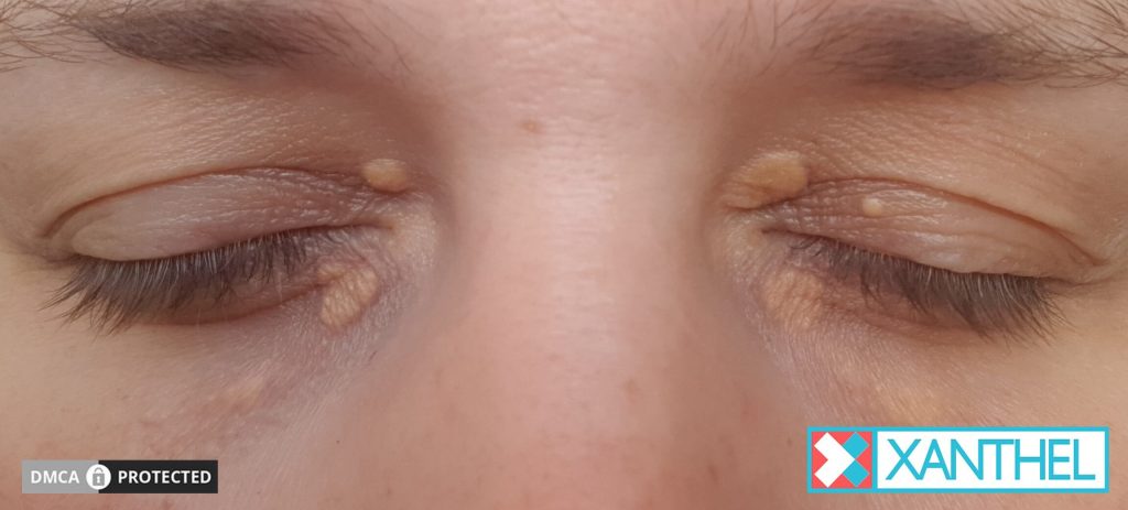 Understanding Xanthelasma Appearing Beneath the Eyelid