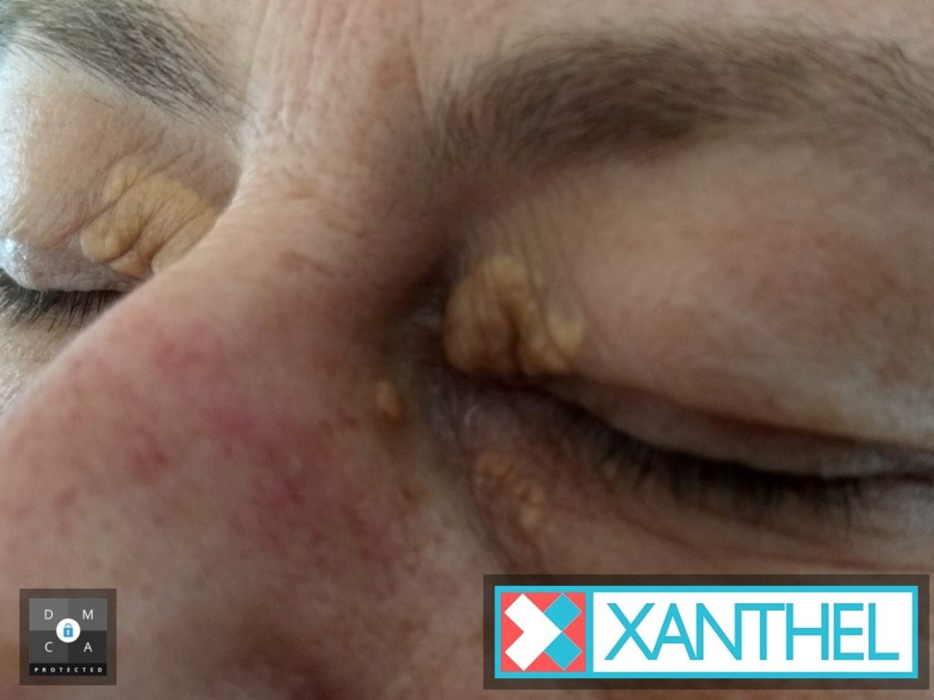 Xanthelasma Compared to Warts - Understanding the Differences