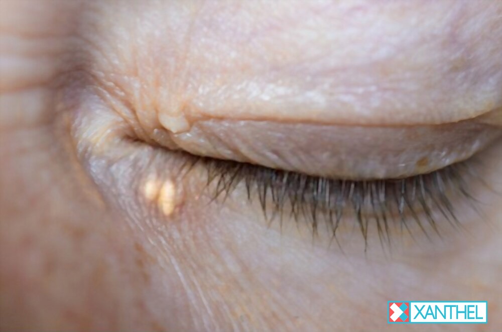 Guide to Xanthelasma Deposits Appearing on Both Eyelids