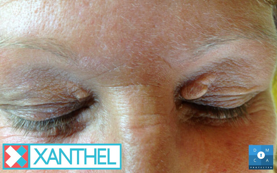 Understanding Xanthelasma Palpebrarum - Deposits on the Eyelids