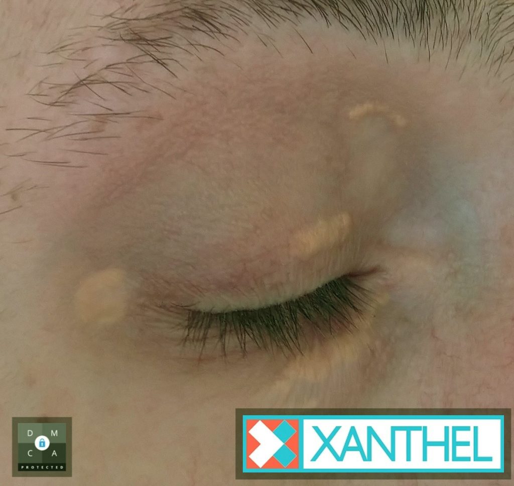Xanthoma Versus Xanthelasma - A Clear Distinction
