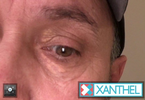 Characteristics of Xanthelasma - Understanding Small Deposits
