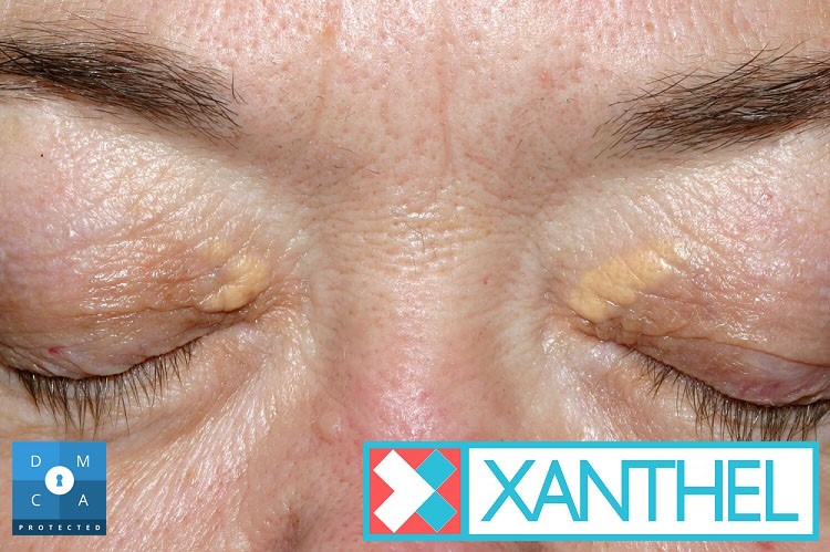 Monitoring Cholesterol - Its Impact on Xanthelasma