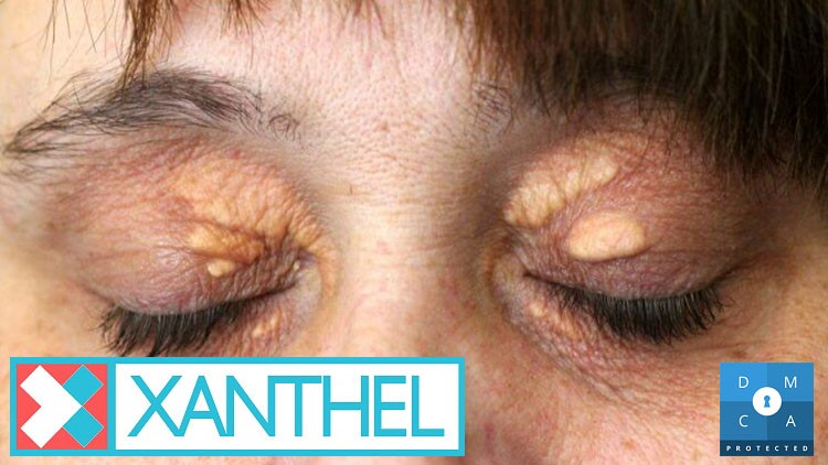 Xanthoma Versus Xanthelasma - A Clear Distinction