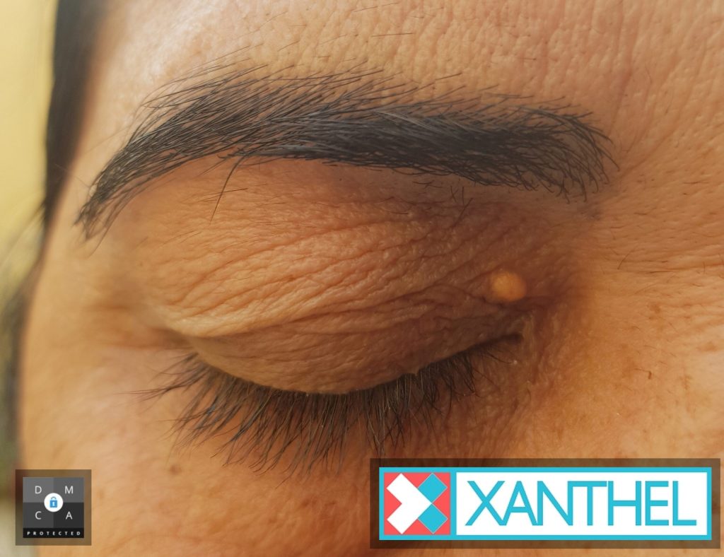 Understanding Xanthelasma Palpebrarum - Deposits on the Eyelids