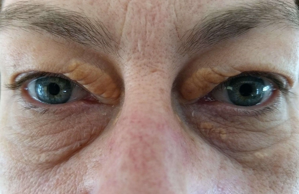 Guide to Xanthelasma Deposits Appearing on Both Eyelids