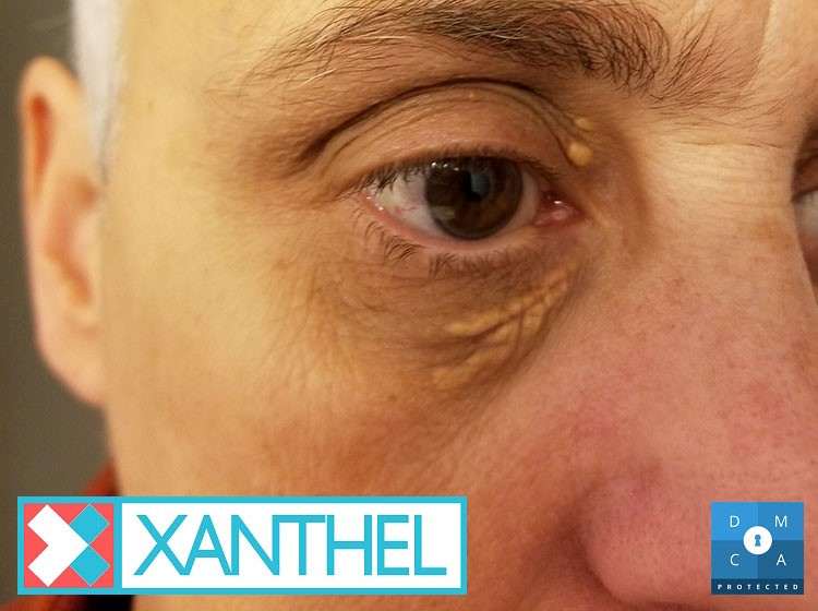 Comprehensive Review -Creams for Xanthelasma Patches