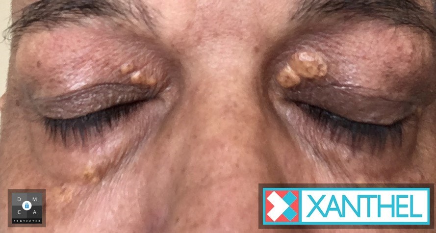 Comprehensive Review -Creams for Xanthelasma Patches