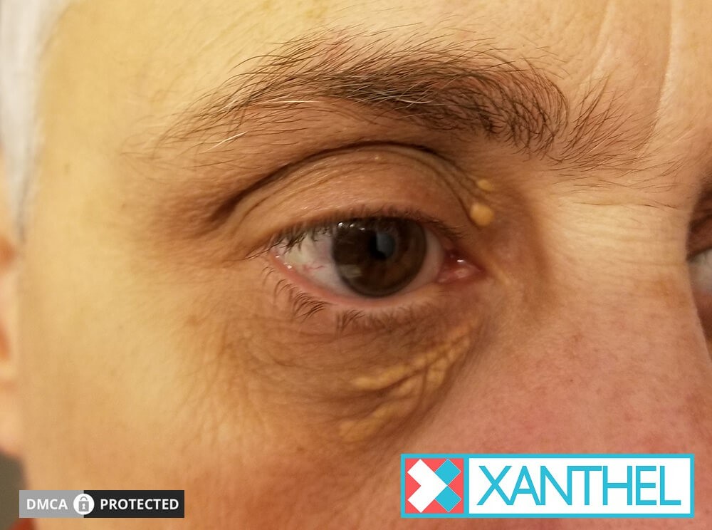 Xanthoma Versus Xanthelasma - A Clear Distinction