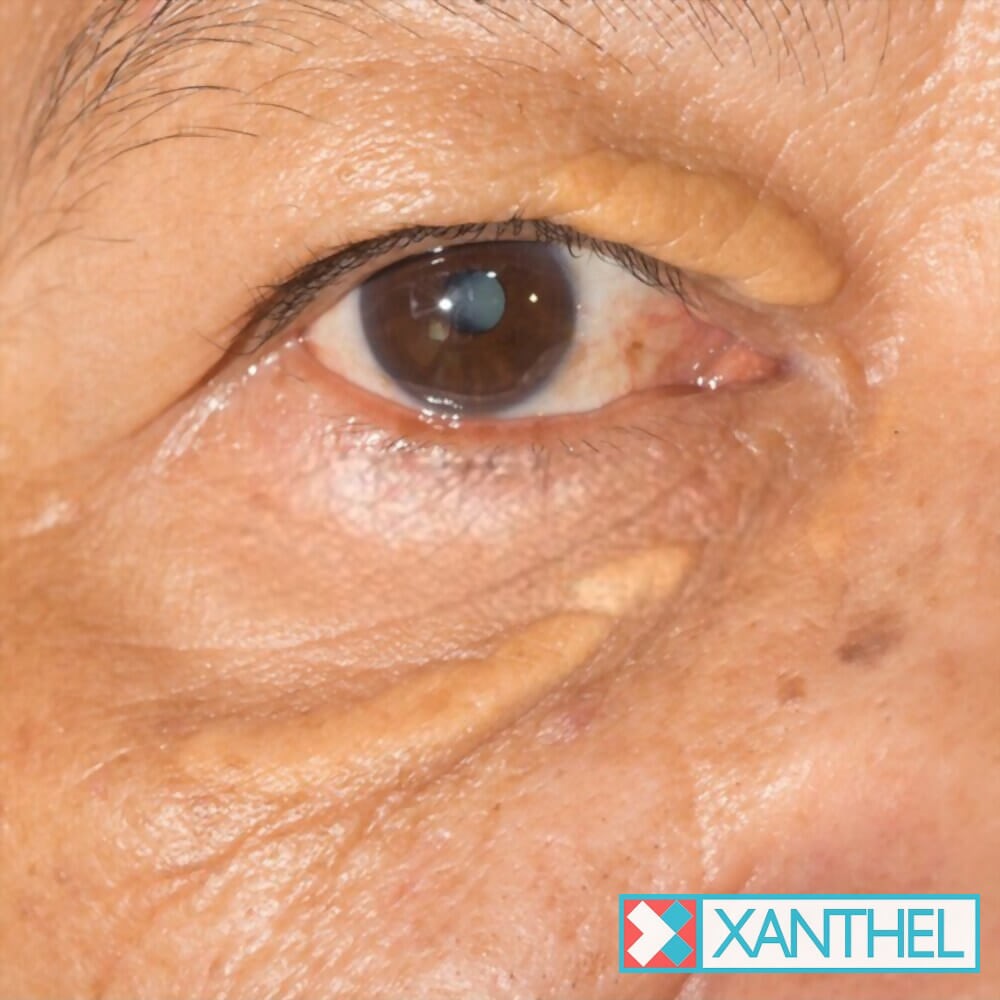 Xanthelasma on the Forehead? A Guide to Its True Locations