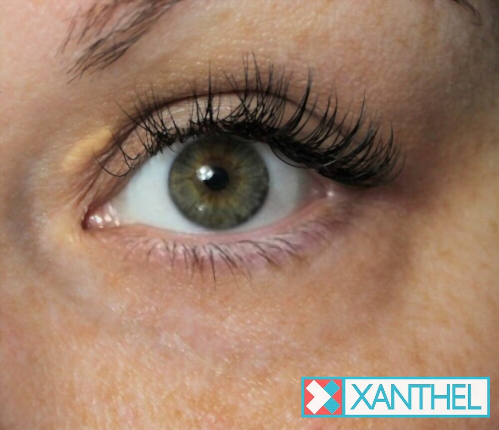 Focus on Periorbital Xanthelasma - Deposits Surrounding the Eyes
