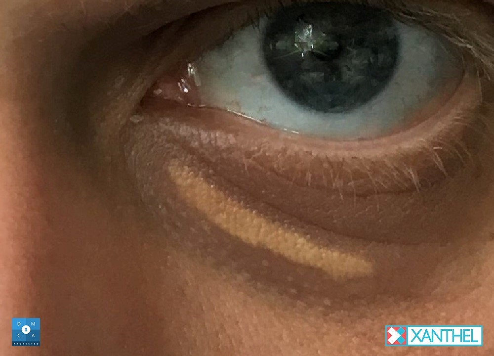 Xanthelasma Compared to Warts - Understanding the Differences