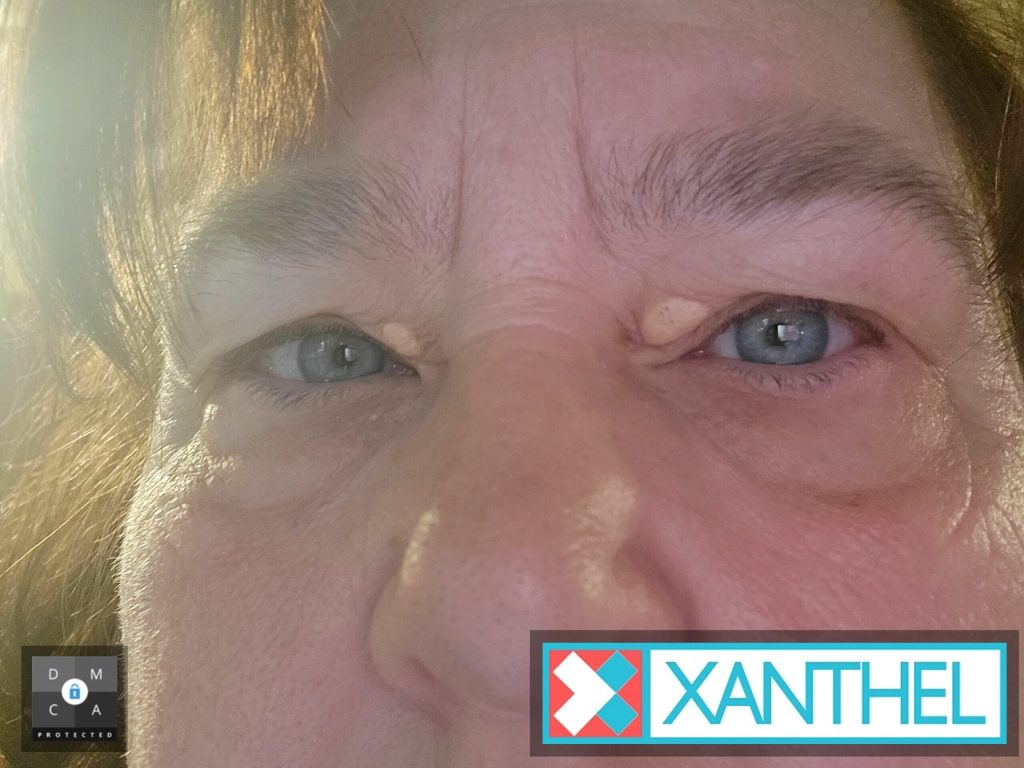 Xanthoma Versus Xanthelasma - A Clear Distinction