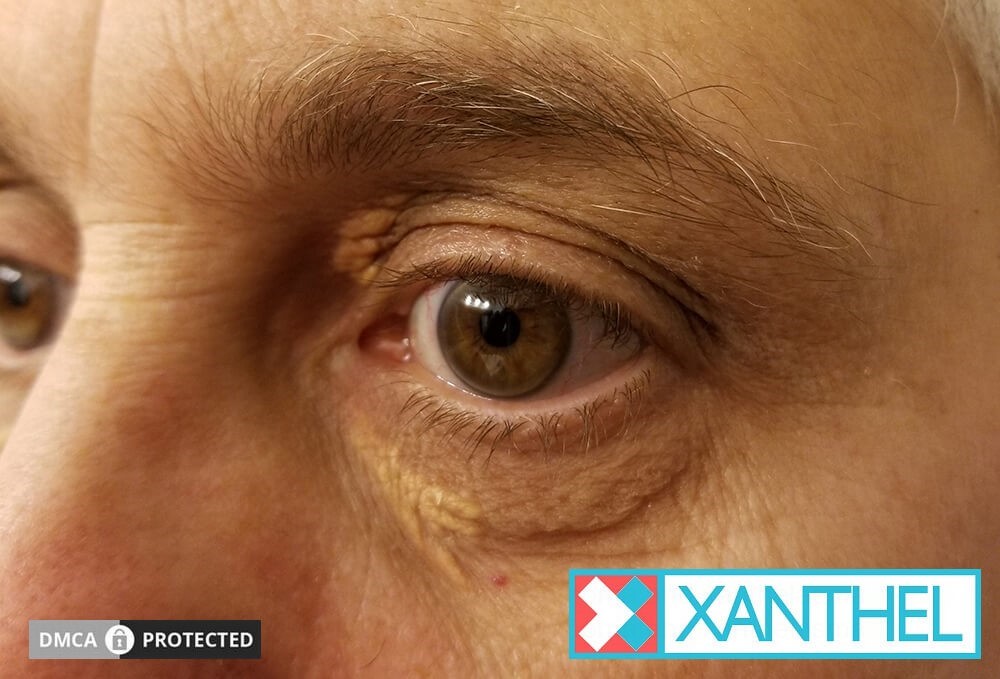 Eyelid Xanthomas - Understanding These Skin Deposits