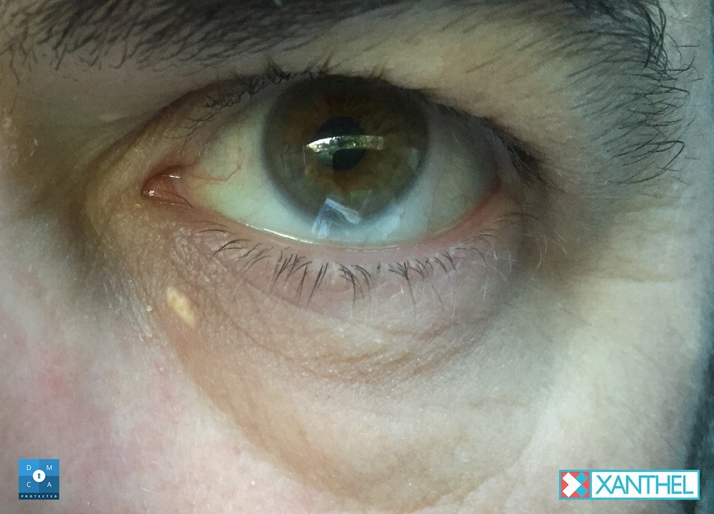 Xanthomas Around the Eyes - A Closer Look at Xanthelasma