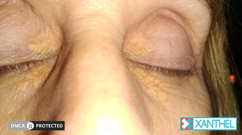 cholesterol deposits removal